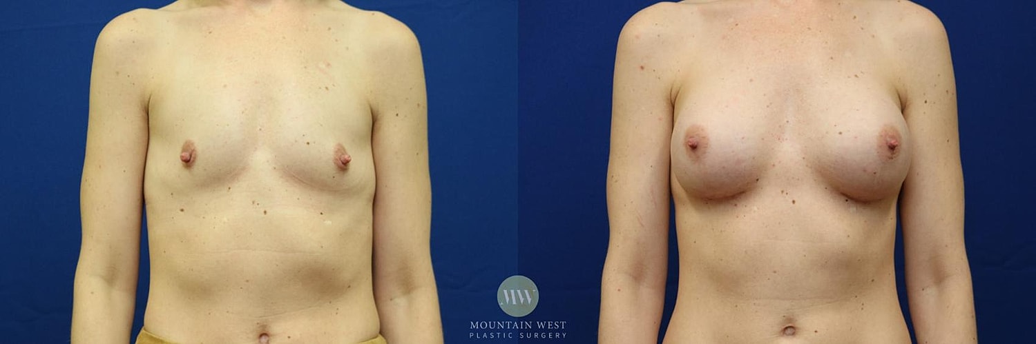 Breast Augmentation Before & After