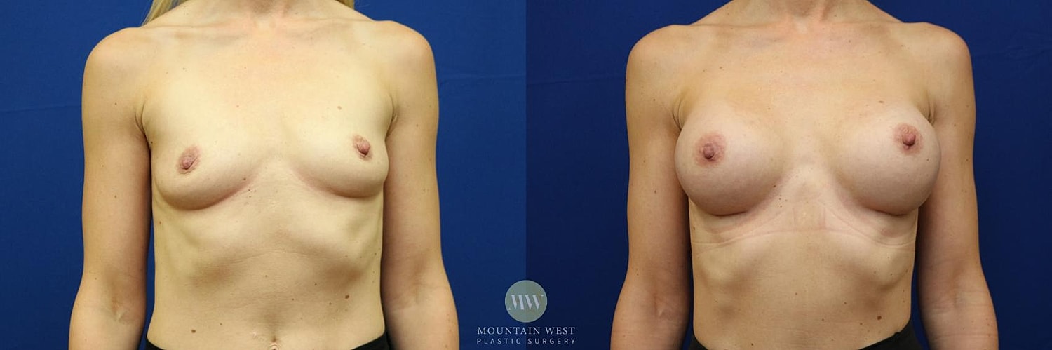 Breast Augmentation Before & After
