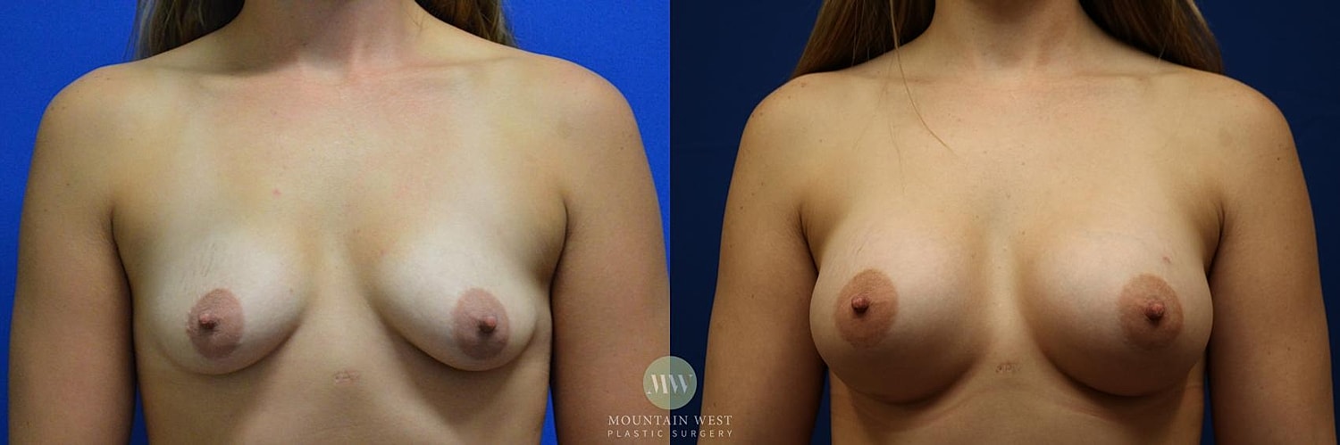 Breast Augmentation Before & After
