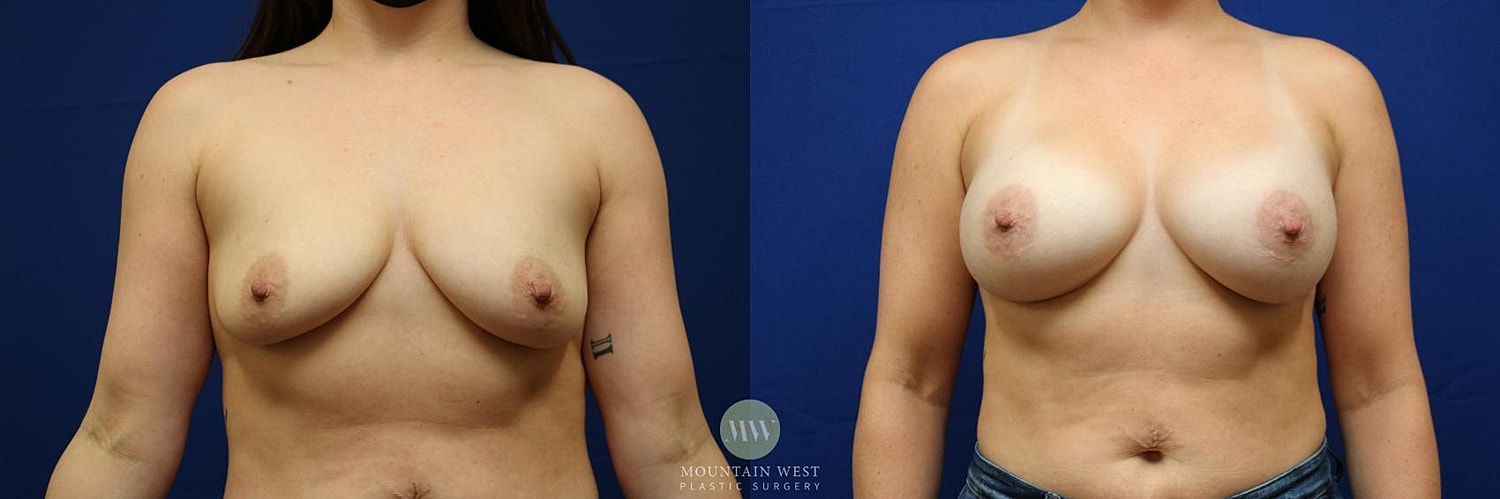 Breast Augmentation Before & After