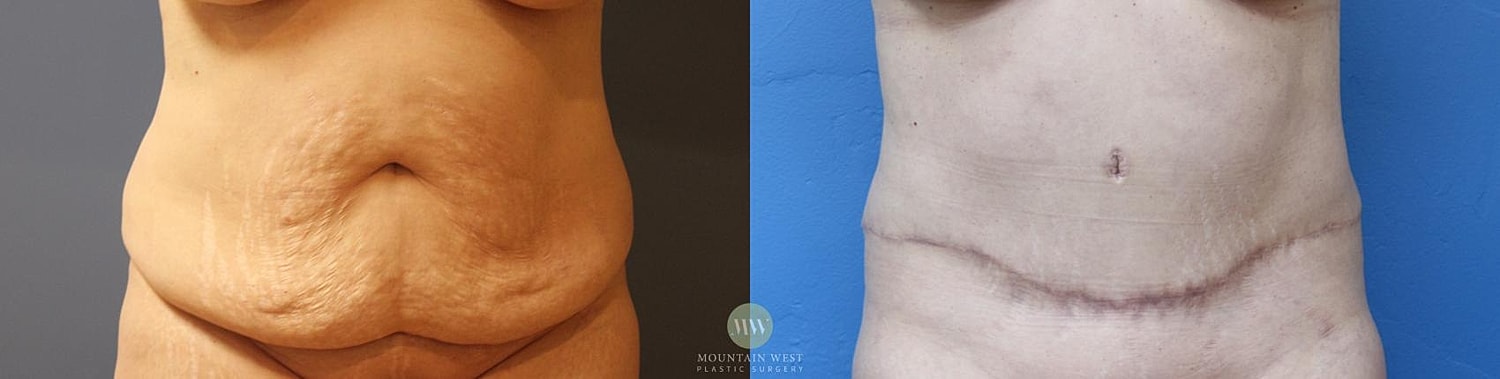 Drainless Tummy Tuck Before & After