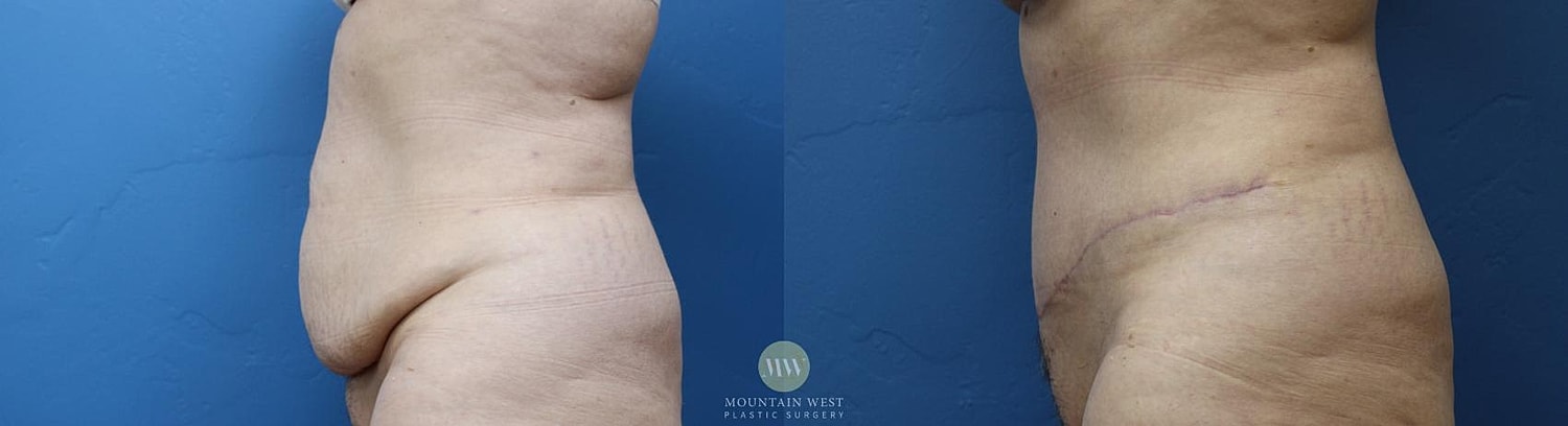 Drainless Tummy Tuck Before & After