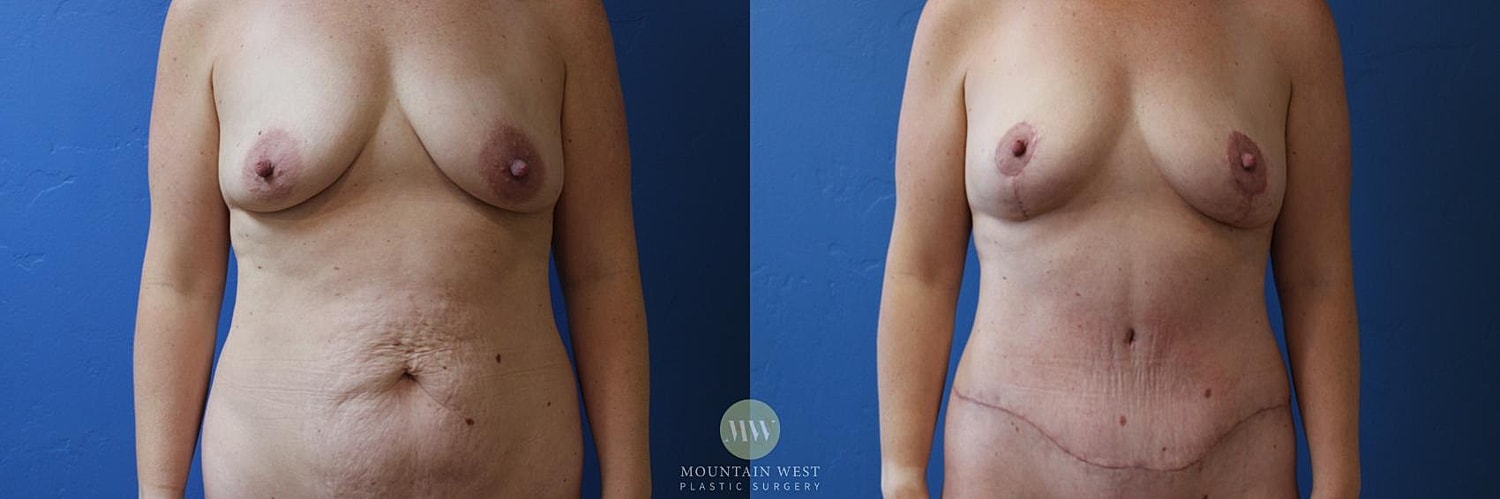 Drainless Tummy Tuck Before & After