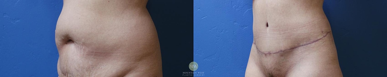 Abdominoplasty Before & After