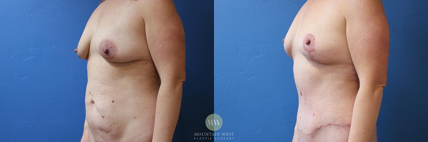 Abdominoplasty Before & After