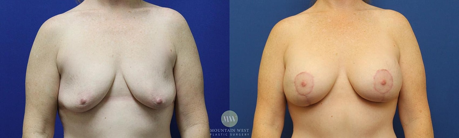 Breast Lift With Augmentation Before & After