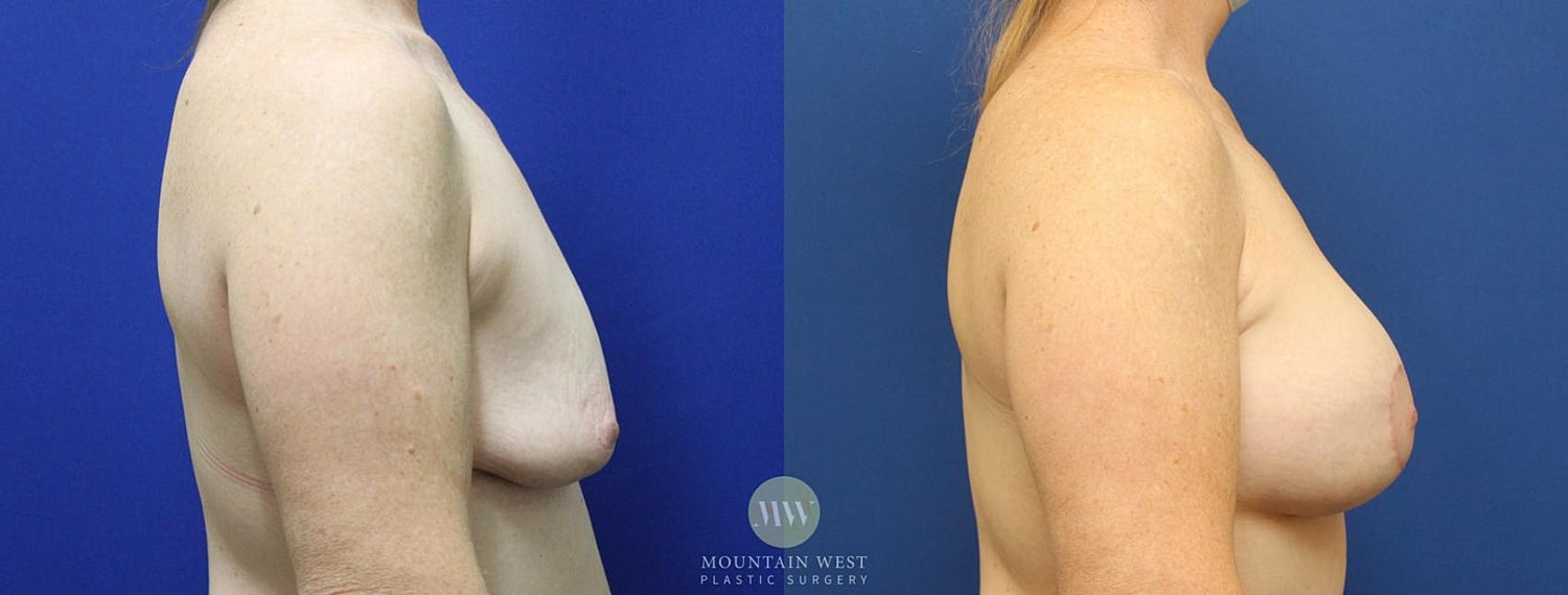 Breast Lift With Augmentation Before & After
