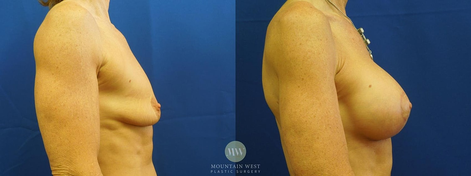 Breast Lift With Augmentation Before & After