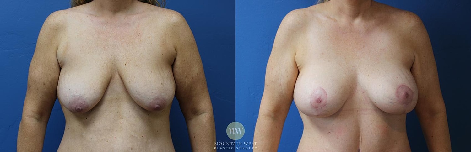 Breast Lift With Augmentation Before & After