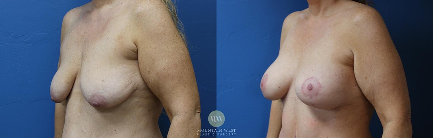 Breast Lift With Augmentation Before & After
