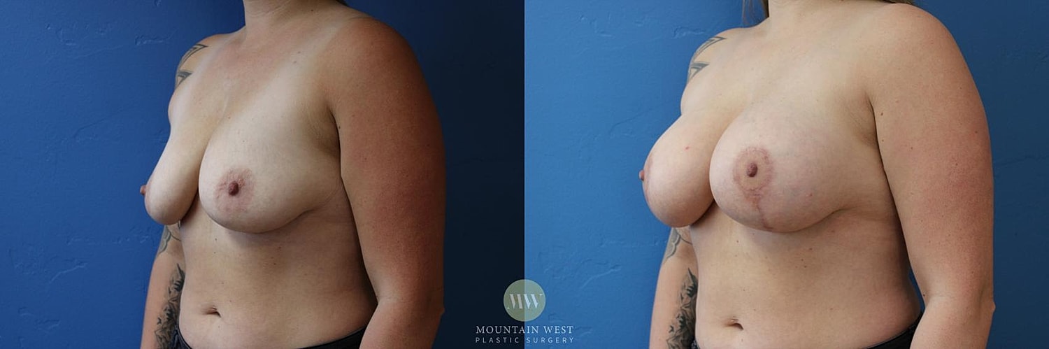 Breast Lift With Augmentation Before & After