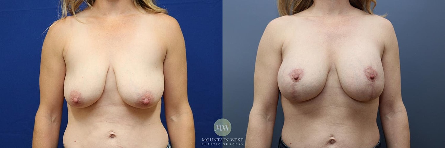 Breast Lift With Augmentation Before & After