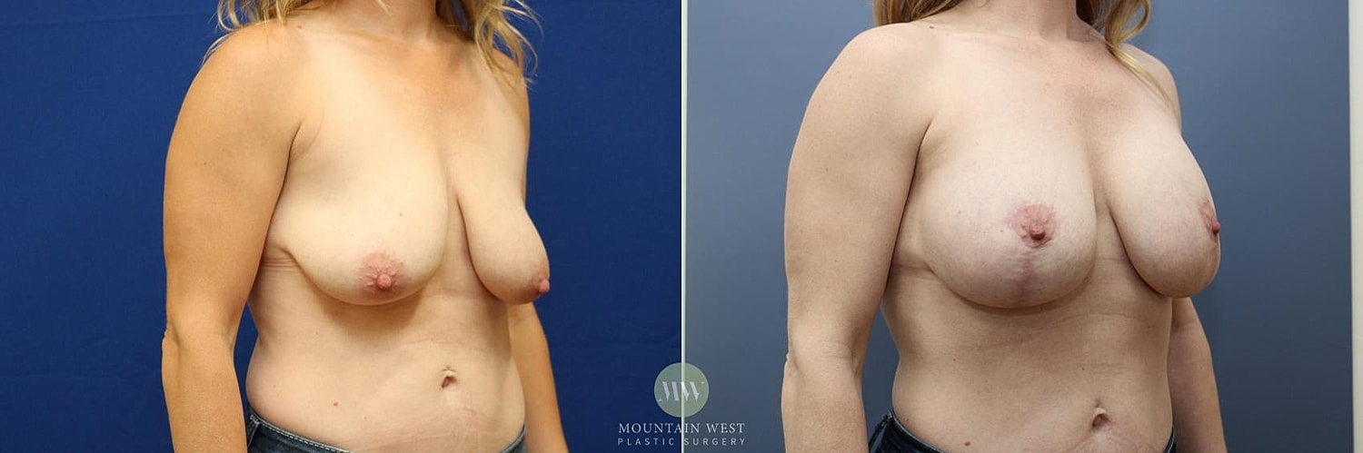 Breast Lift With Augmentation Before & After