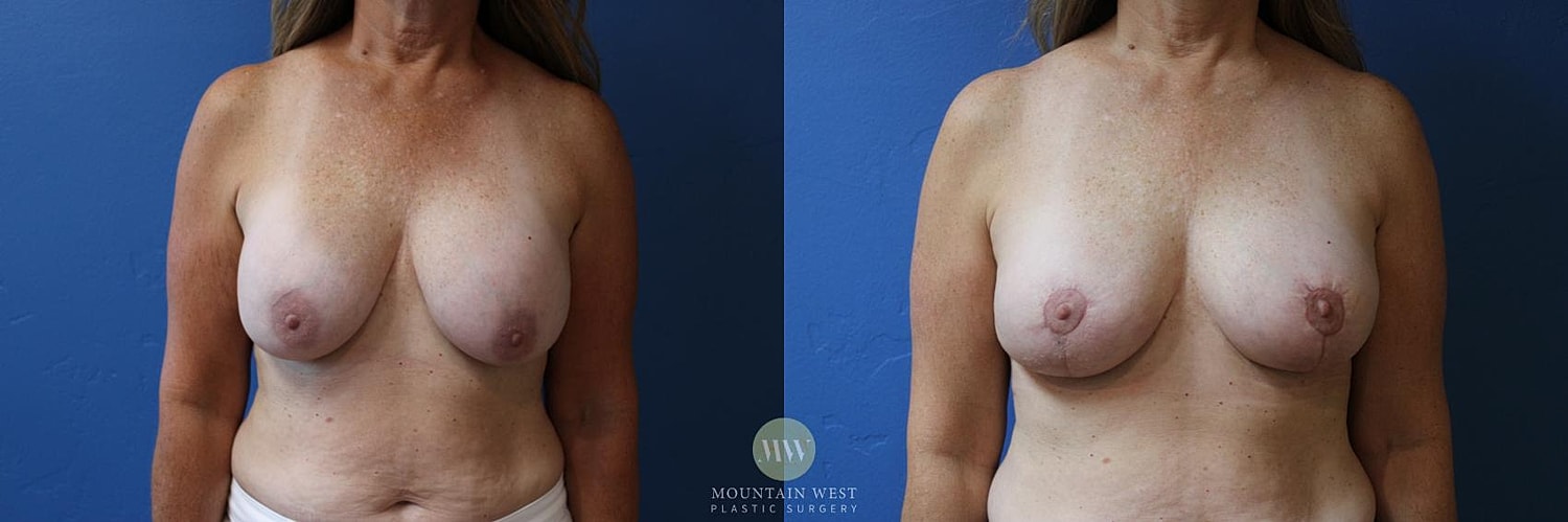 Breast Lift With Augmentation Before & After