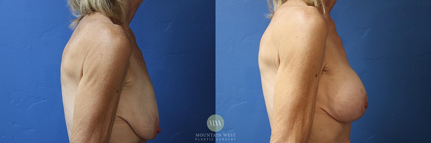 Breast Lift With Augmentation Before & After