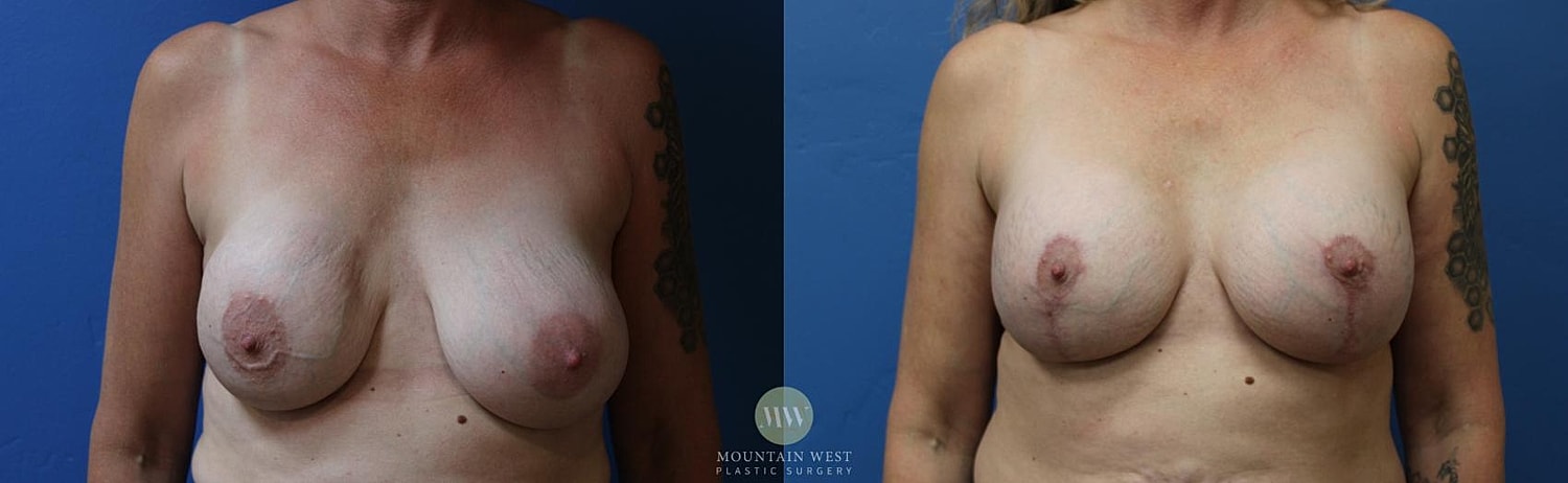 Breast Lift With Augmentation Before & After