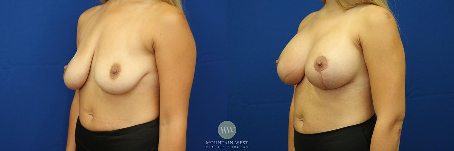 Breast Lift With Augmentation Before & After