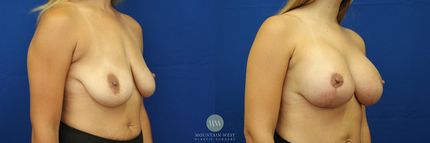 Breast Lift With Augmentation Before & After