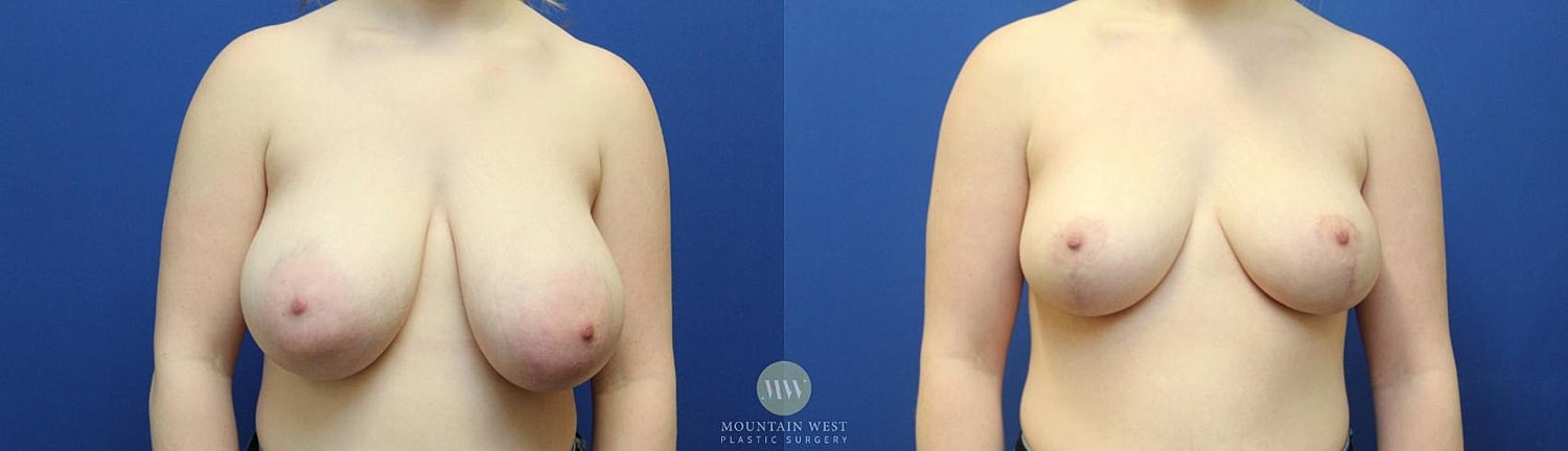 Breast Reduction Before & After