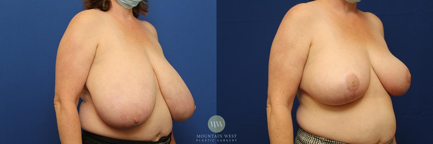 Breast Reduction Before & After