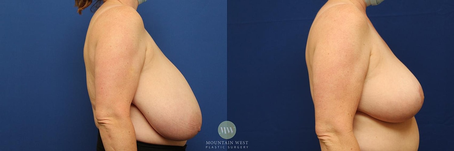 Breast Reduction Before & After
