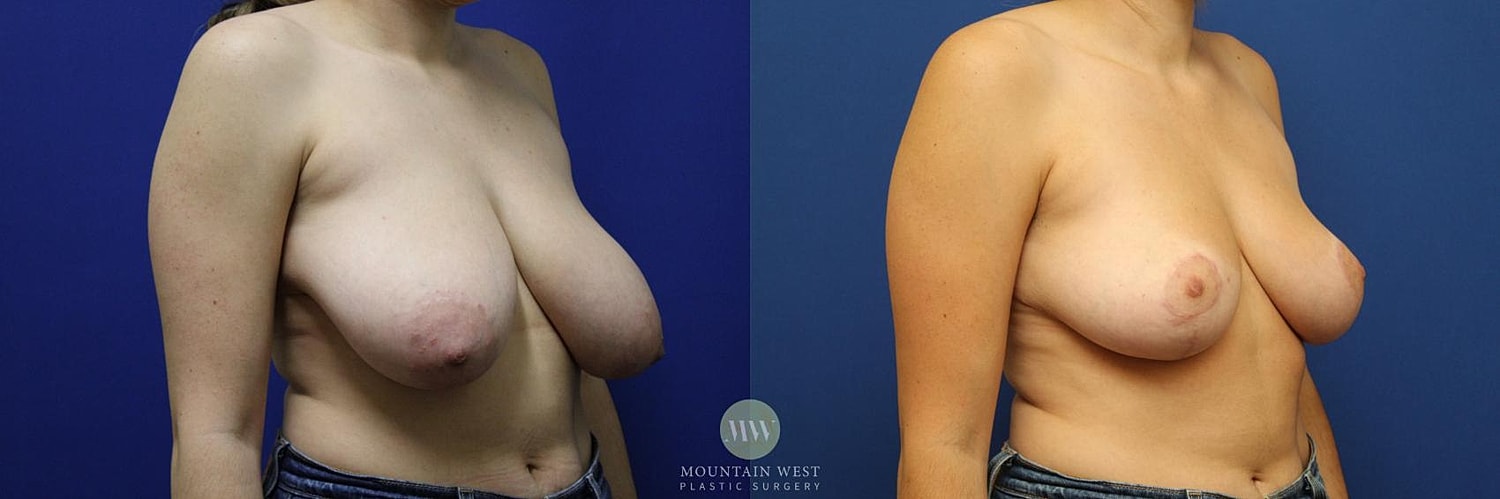 Breast Reduction Before & After