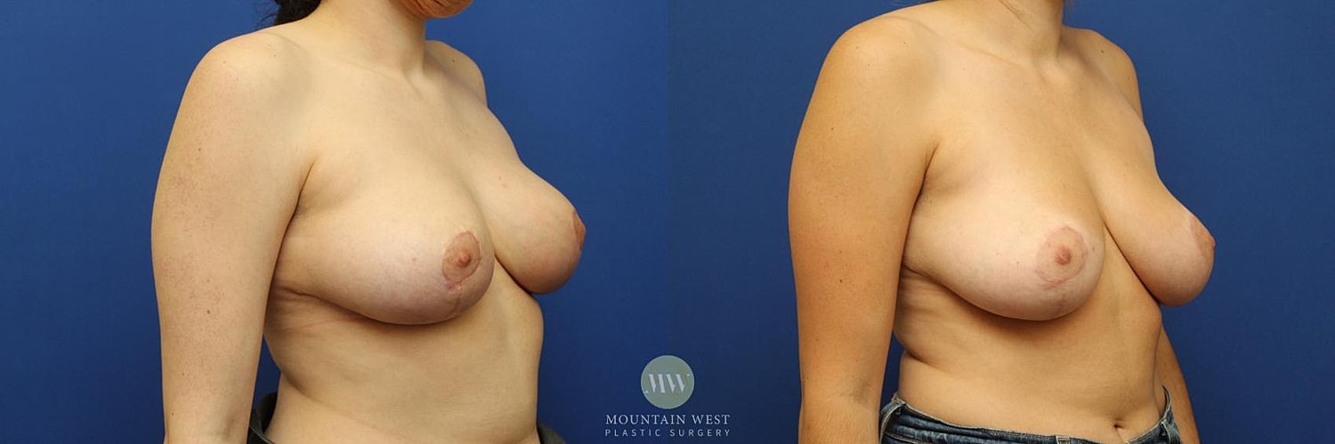 Breast Reduction Before & After