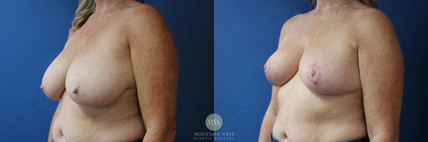 Breast Reduction Before & After