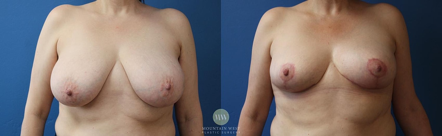 Breast Reduction Before & After