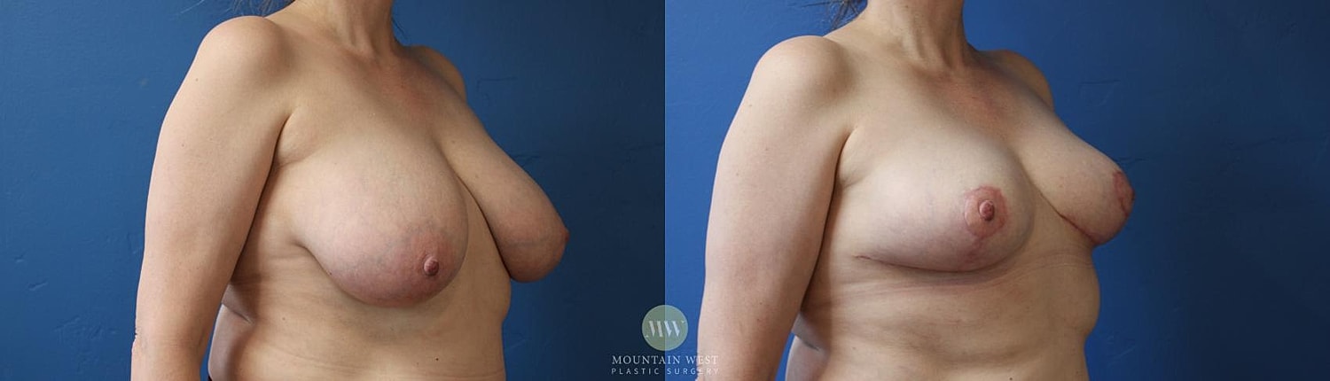 Breast Reduction Before & After