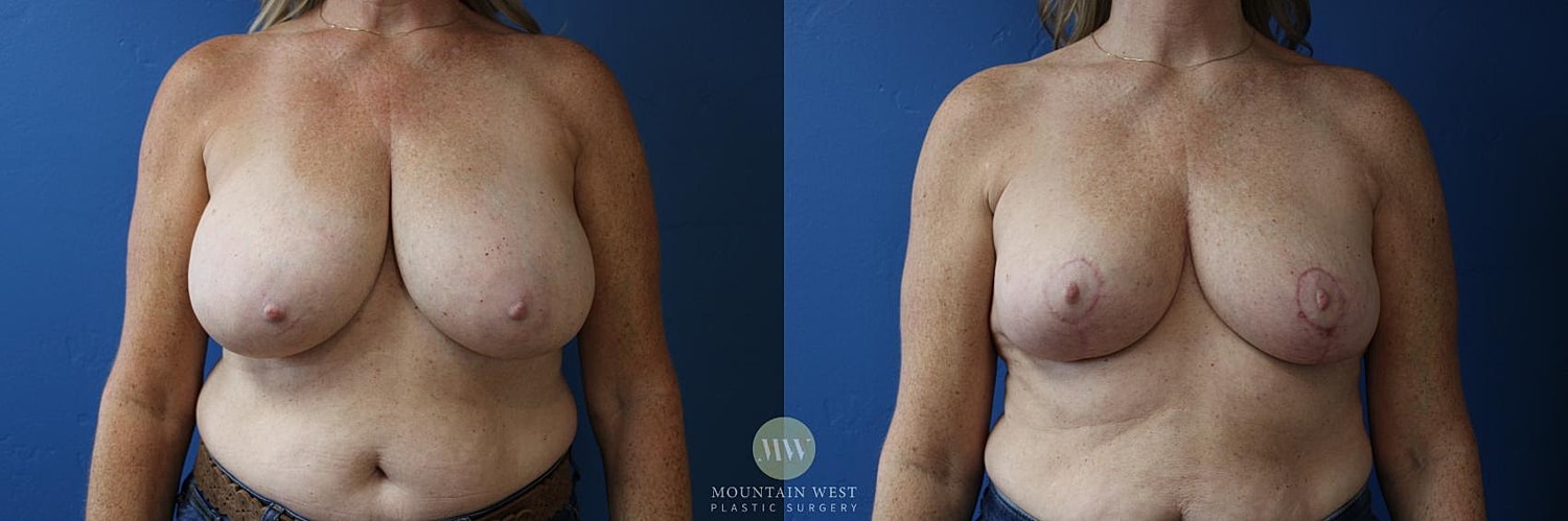 Breast Reduction Before & After