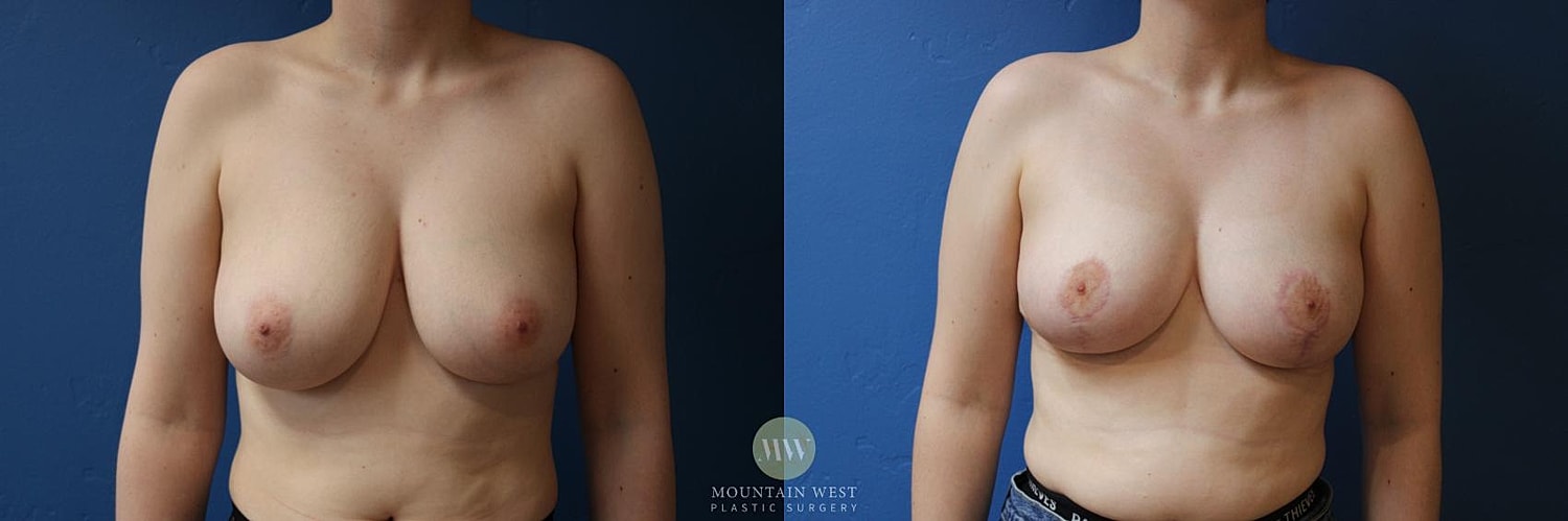 Breast Reduction Before & After