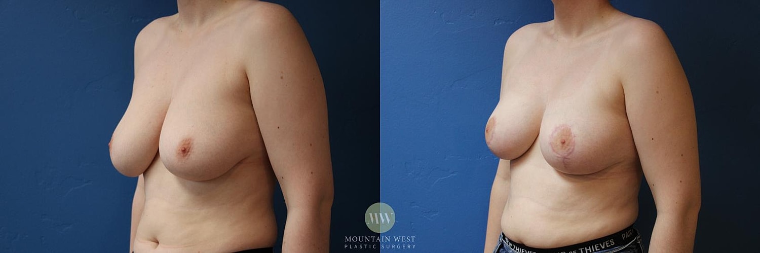 Breast Reduction Before & After