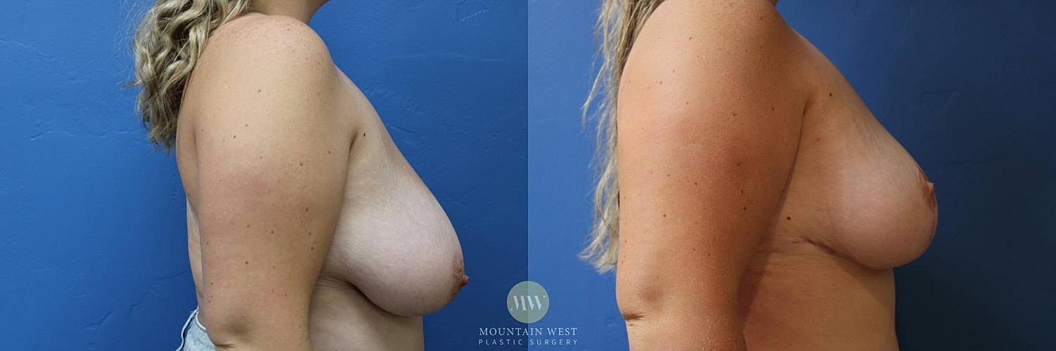 Breast Reduction Before & After