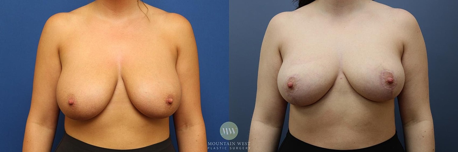 Breast Reduction Before & After