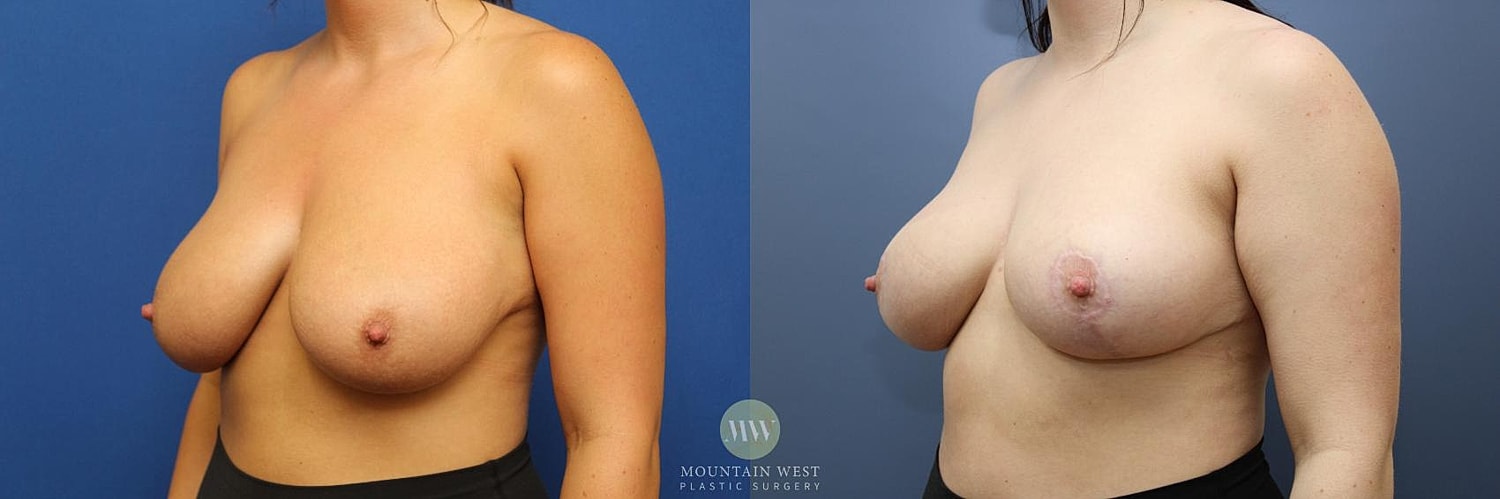 Breast Reduction Before & After