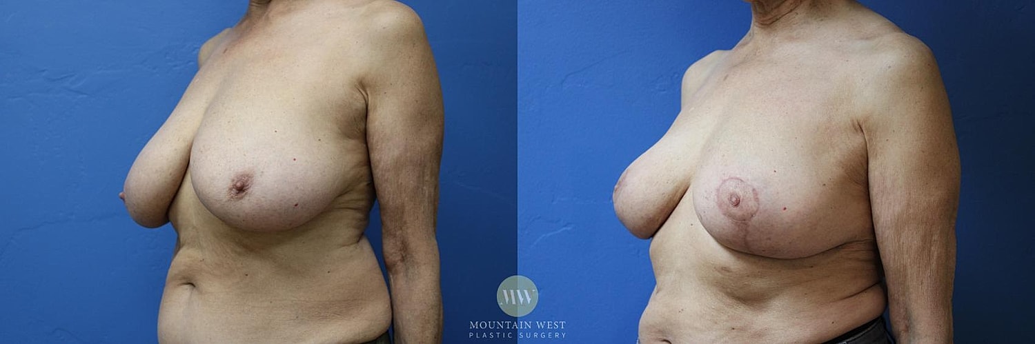 Breast Reduction Before & After
