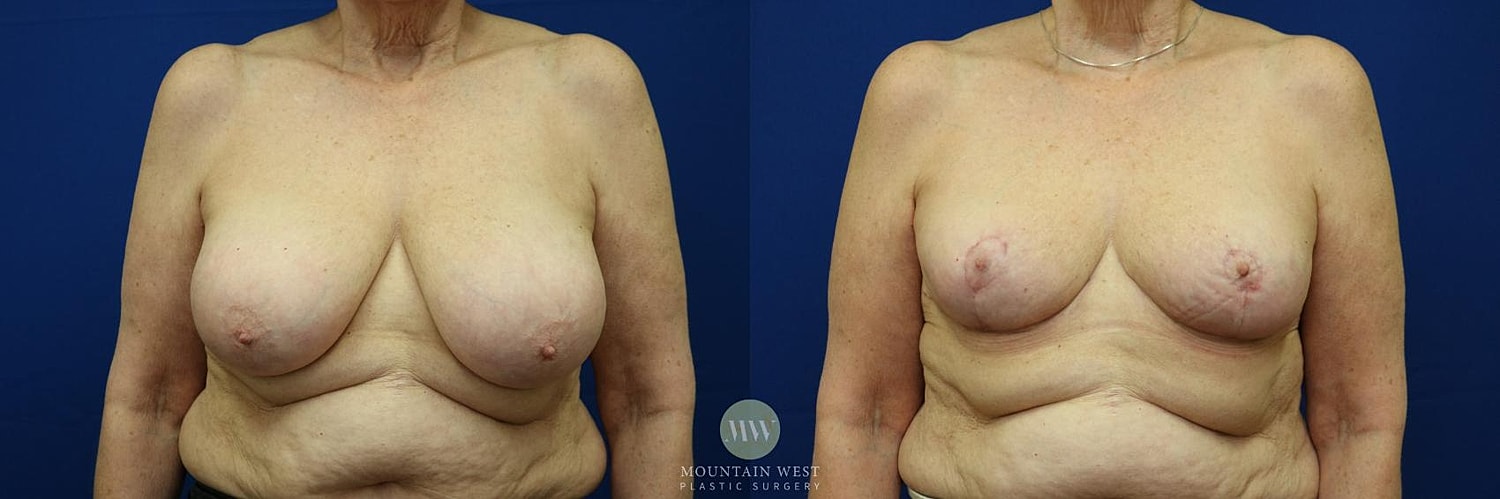 Breast Reduction Before & After