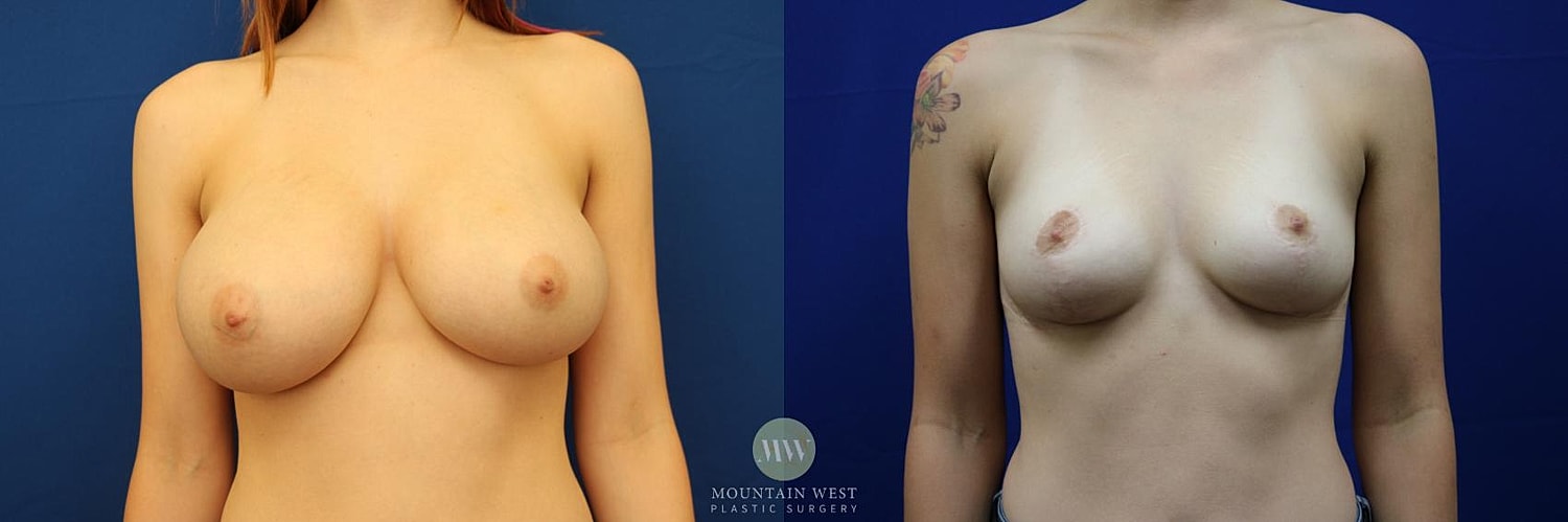 Breast Reduction Before & After