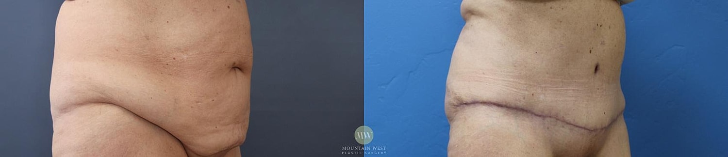 Body Contouring After Weight Loss Before & After