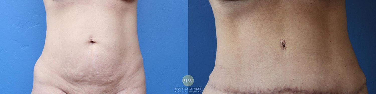 Body Contouring After Weight Loss Before & After