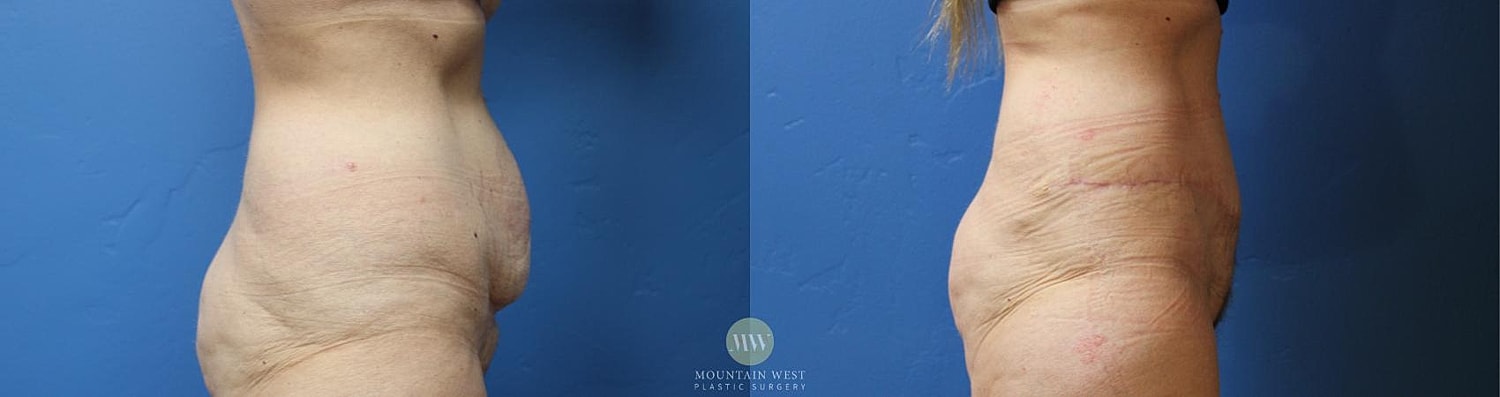 Body Contouring After Weight Loss Before & After