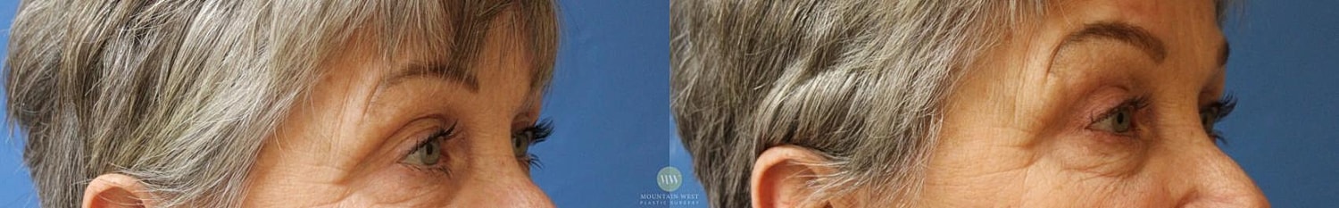 Brow Lift Before & After