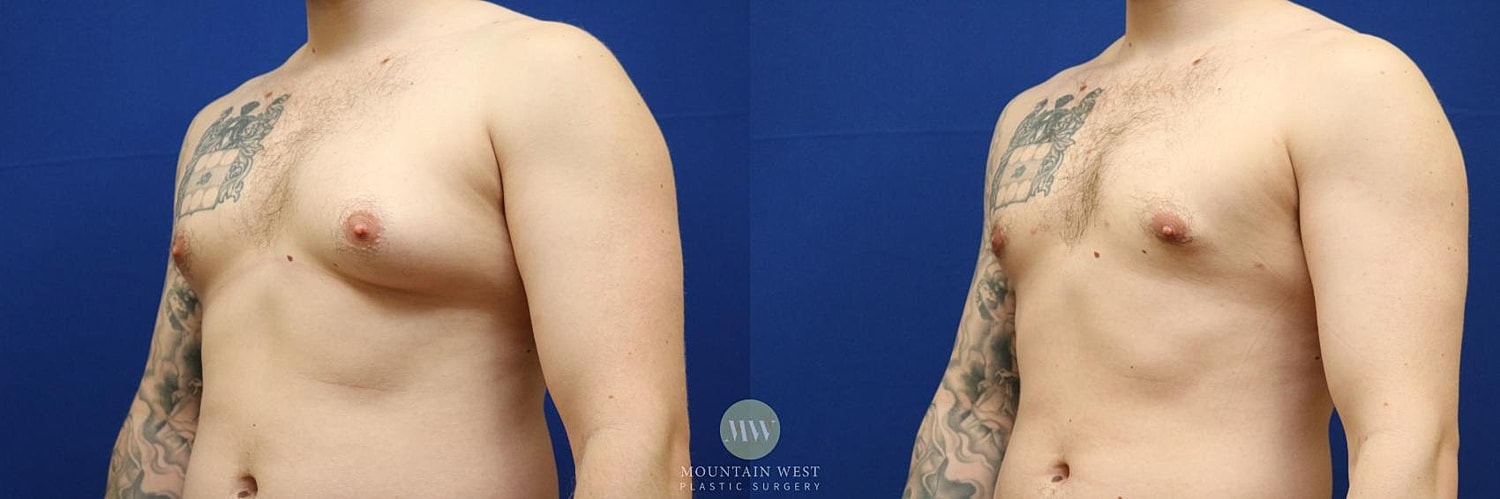 Male Breast Reduction Gynecomastia Before & After
