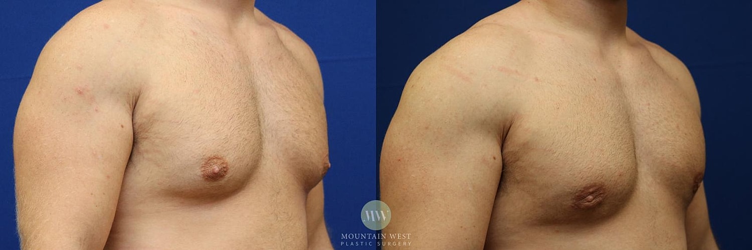 Male Breast Reduction Gynecomastia Before & After