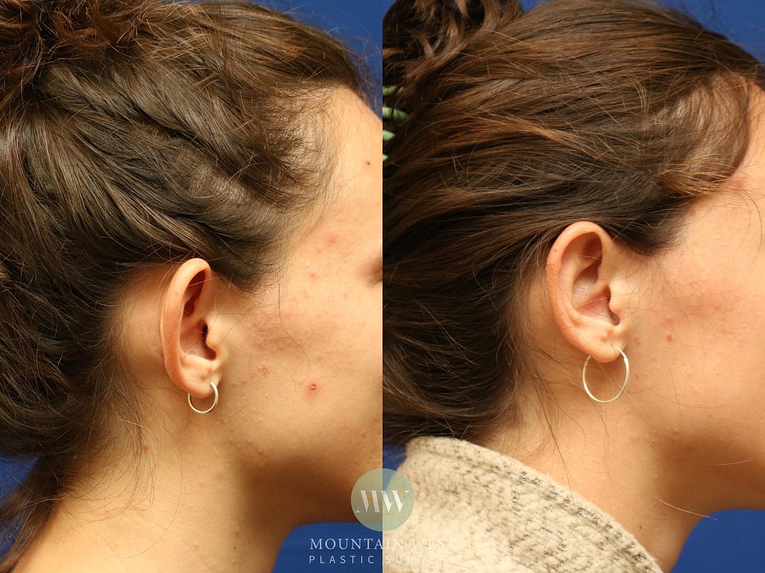 Otoplasty Before & After